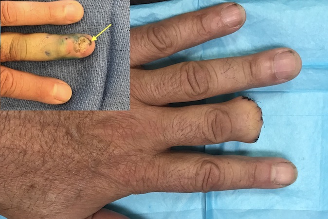 Left long finger after amputation for subungual melanoma