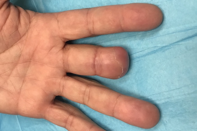 Healed left long finger after amputation for subungual melanoma