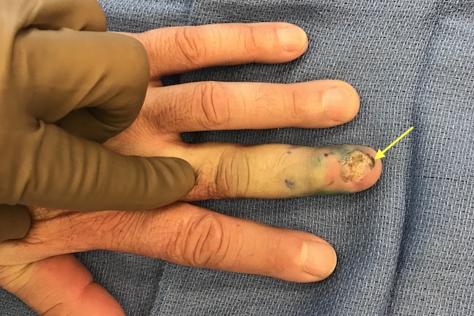 Melanoma subungual left long finger.  Originally this  patient presented as a chronic "infection" and a mass consistent with a subungual granuloma. Silver nitrate cauterization did not resolve the problem. The lesion and black residue from the silver nitrate was excised.  Diagnosis of melanoma was made. Photo shows left long finger after sentinel node injection and before amputation. Note pigmented tissue arrow.
