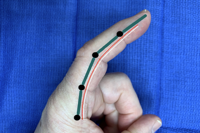 Mid-Axial Line (mid-lateral line) in green with black dots marking dorsal end of the flexion creases.  Digital artery location in red and digital nerve location in white.