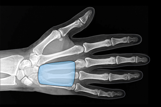 Midpalmar Space Infection: The midpalmar space is a potential space between the volar interosseous fascia, the flexor sheath, the oblique and hypothenar septum. Infection is usually secondary to spread of infection from flexor sheath of long and ring fingers.