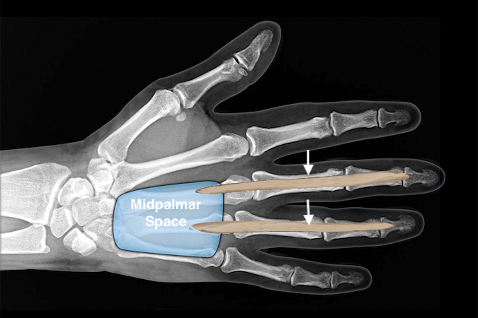 Infections of the long and ring finger flexor tendon sheaths (arrows) can spread into the midpalmar space.