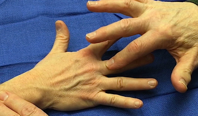 Middle Finger Test for Radial Tunnel Syndrome