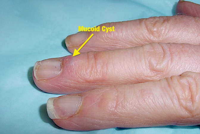 Mucoid Cyst of Long Finger with deformity of nail