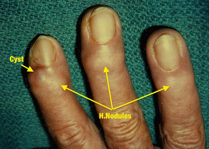 Mucoid Cyst with OA (Herberden's Nodules)
