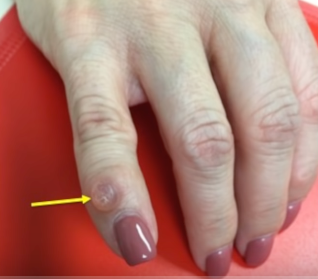 Mucoid Cyst left index finger after spontaneous rupture and drainage