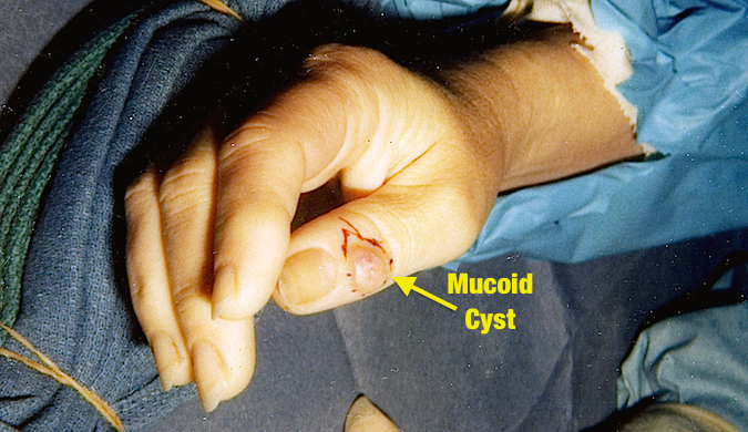 Mucoid Cyst excision right thumb