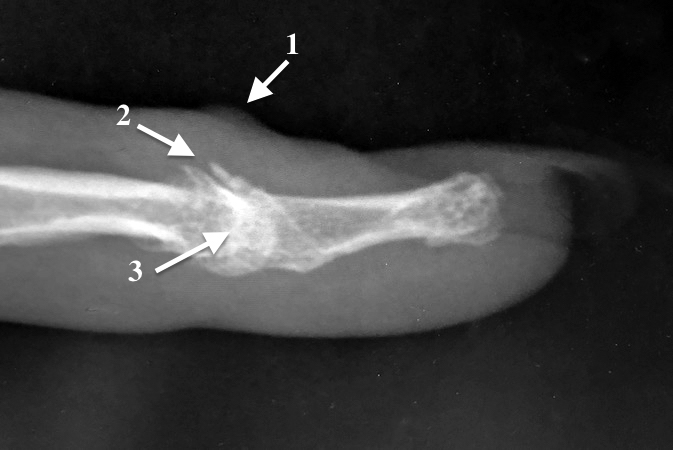 X-ray finger tip: 1.mucoid cyst;  2.dorsal osteophytes; 3.DIP arthritis