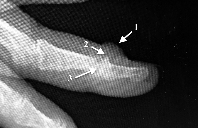 X-ray finger tip#2: 1.mucoid cyst;  2.dorsal osteophytes; 3.DIP arthritis
