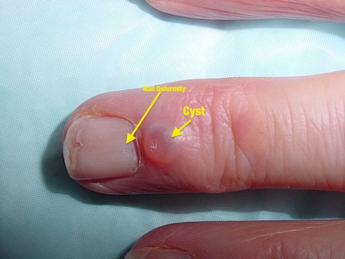 Mucoid Cyst with deformity of nail because cyst putting pressure of germinal nail matrix.
