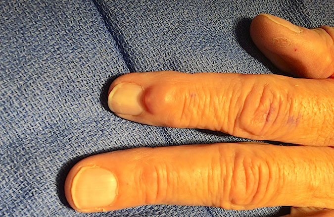 Mucoid Cyst left index finger with concave nail deformity.