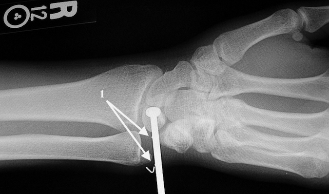 Nail Gun Injury AP X-ray Right Wrist DRUJ. Note barbs on nail.