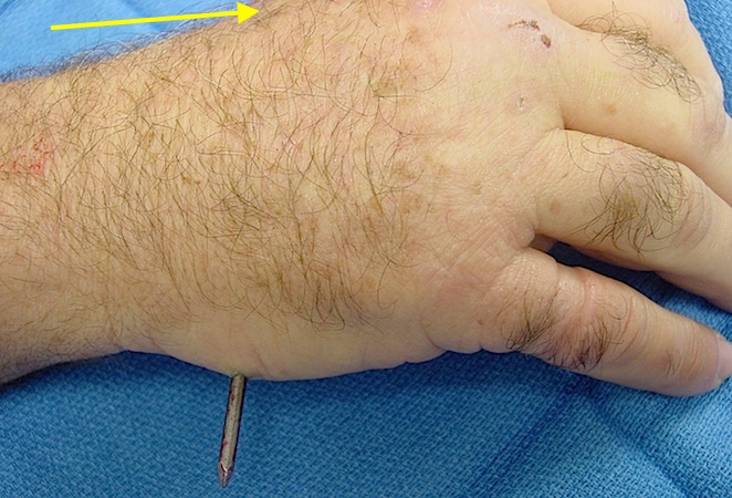 Nail Gun Injury Right Dorsal Proximal Hand. Head of nail at arrow