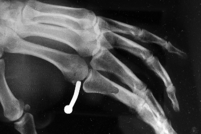 Nail Gun Injury to base of left index finger. Oblique X-ray suggests injury to MP joint and the radial collateral ligament.