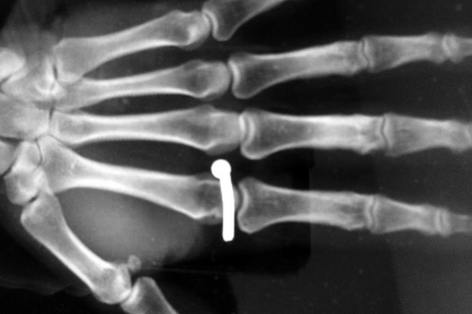 Nail Gun Injury to base of left index finger. No obvious fracture