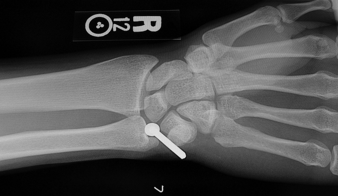 Nail Gun Injury AP X-ray Right Wrist DRUJ