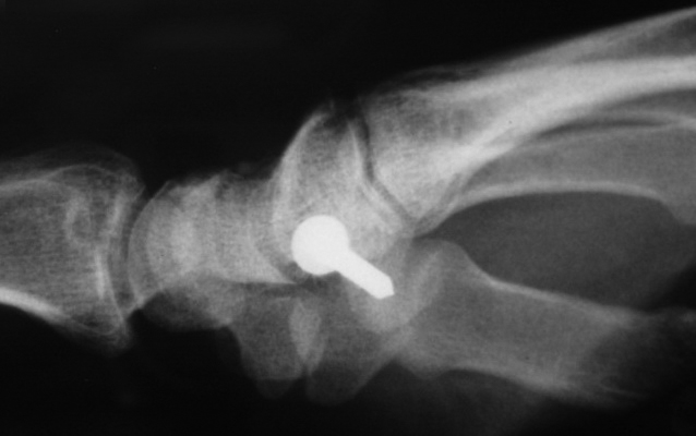 Nail Gun Injury lateral X-ray Left Hand