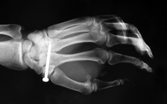 Nail Gun Injury oblique X-ray Left Hand