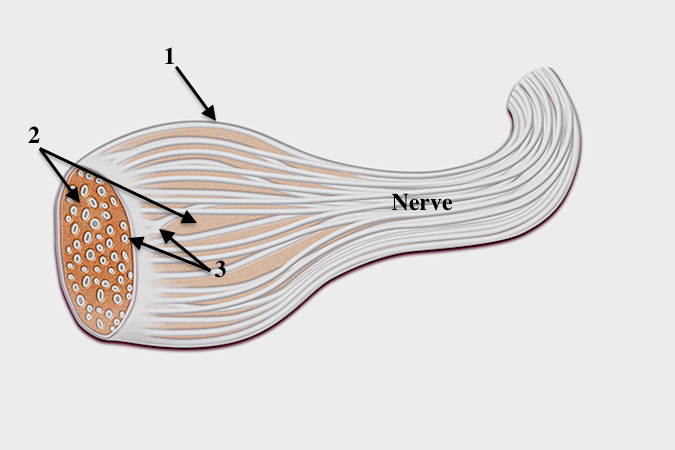 Neurofibroma of a peripheral nerve: 1- epineurium; 2- neurofibroma  tumor tissue interspersed between the nerve fibers; 3- fascicular groups