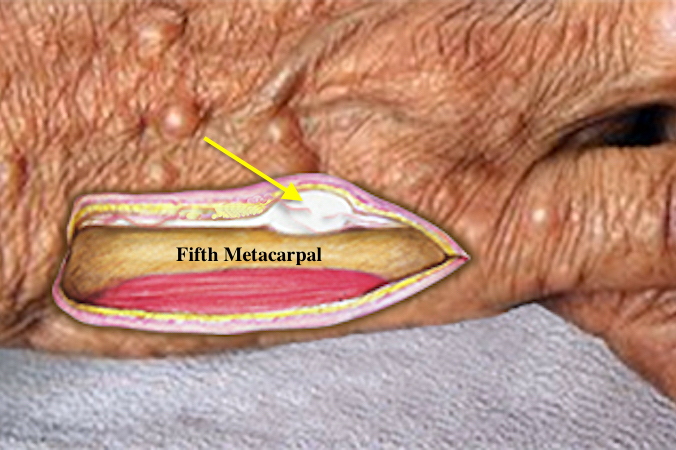 Cutaneous neurofibroma (arrow) associated with neurofibromatosis (NF1, von Recklinghausen disease)