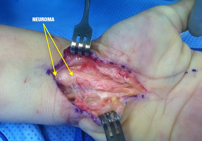Median Nerve Neuroma-in-Continuity