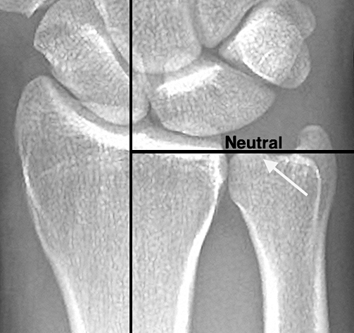 Ulnar Variance -When the distal radius and distal ulna are equal in length at the distal radioulnar joint, the ulnar variance is neutral. In this X-ray the ulnar variance is being measured with the method of perpendiculars. The forearm is in neutral rotation, wrist at neutral deviation and flexion/extension, and the elbow at 90 degrees of flexion. The X-ray beam is at a zero-degree angle of incidence for this PA view.