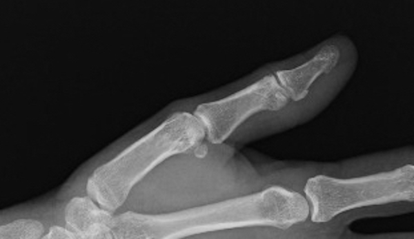Trigger thumbs have normal X-rays