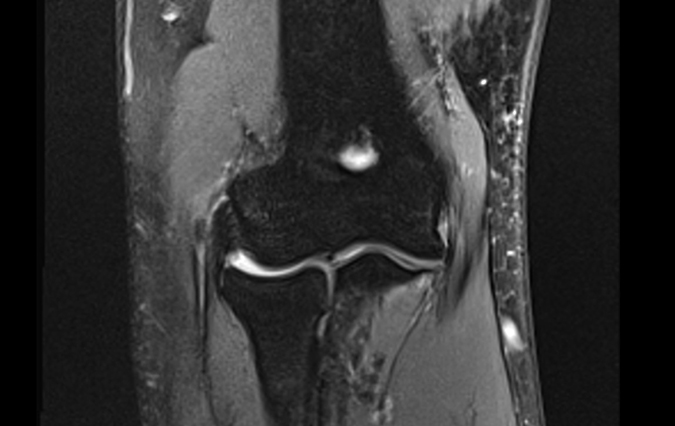 Normal elbow AP MRI