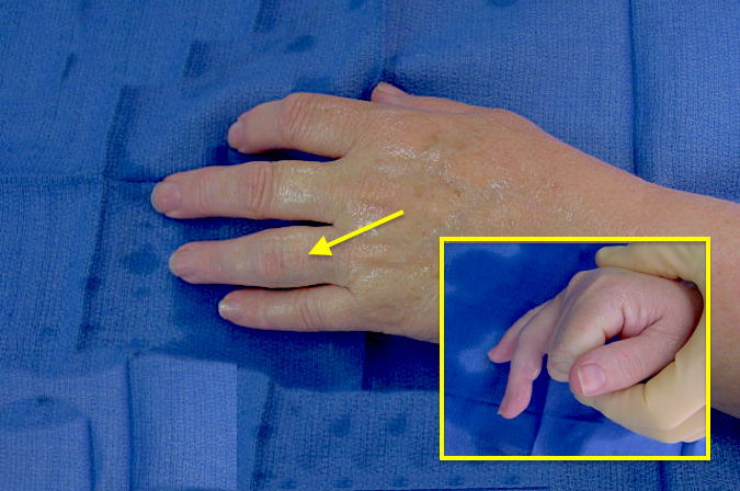 OA left ring finger PIP joint (arrow).  Note enlarged joint size and lack of flexion (insert).