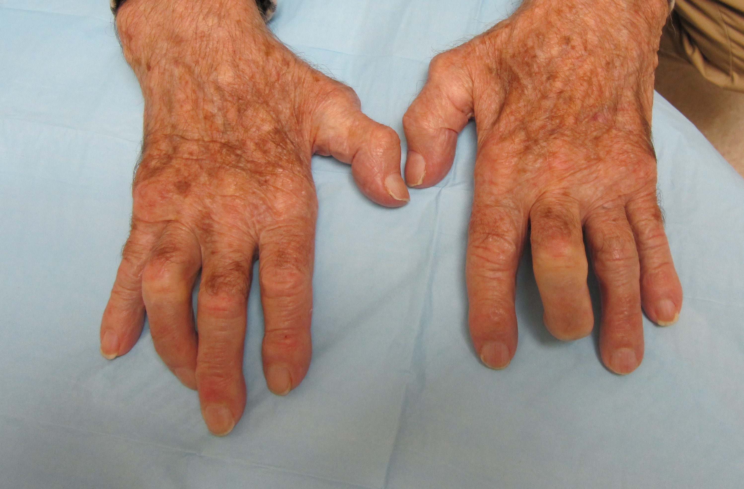 Severe diffuse bilateral hand Osteoarthritis in patient with severe cubital tunnel syndromes.