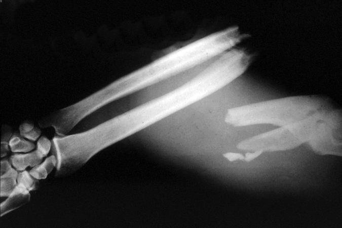 Severely traumatized right forearm (AP X-ray) with open double bone forearm fractures.