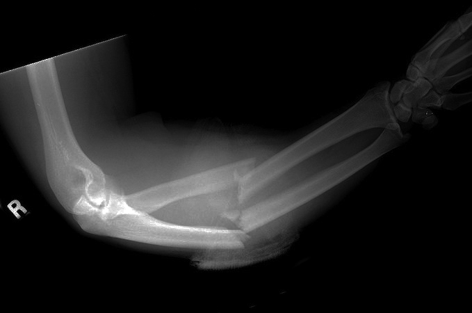 Severely traumatized right forearm (Oblique) X-ray) with open double bone forearm fractures.