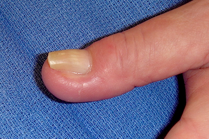 Osteomyelitis of the distal phalanx after unsuccessful treatment of chronic paronychia and subungual infection in a diabetic patient.