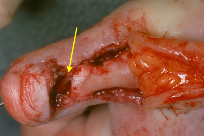 Osteomyelitis and septic joint with bone loss (arrow) after open fracture and crush injury.