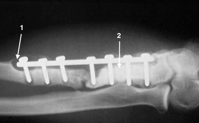 Osteomyelitis after ORIF of open ulna fracture.  Note loose screw and osteolysis (1) and necrotic bone (2)