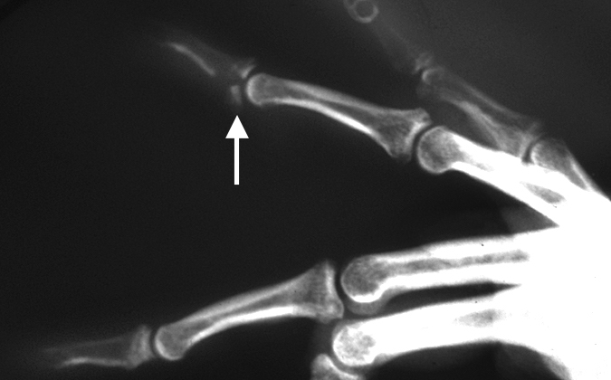 Distal phalanx volar plate avulsion fracture (FDP insertion intact) Note the dorsal subluxation of the larger fragment.