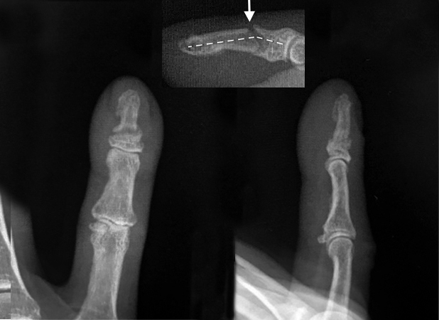 Distal phalanx fracture treated in Stack splint with correction of angulation and healing at 8 weeks.