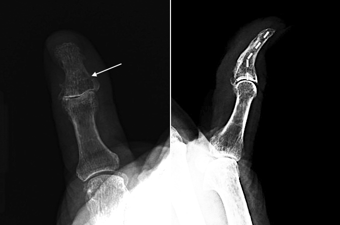 Distal phalanx base fracture in 94 y.o. female complicated by a malunion after Stack splint treatment.