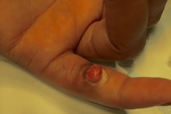 Pyogenic Granuloma left little finger before surgical excision