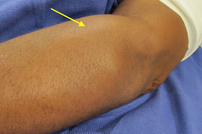 A mass was palpable in the primal dorsal forearm (arrow)