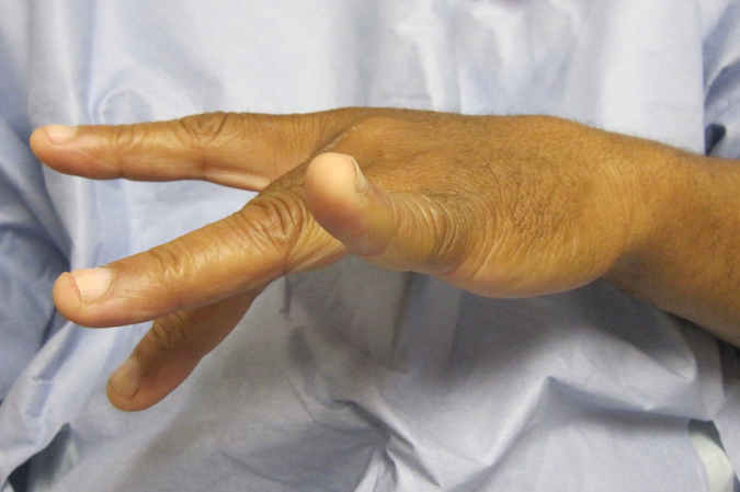 58 y.o. right handed male with a PIN palsy complaining of proximal forearm pain and inability to straighten his fingers on the left.