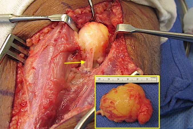 The radial tunnel has been release exposing a large lipoma which is severely stretching the  posterior interosseous nerve (arrow).  The excised lipoma is seen in the insert.