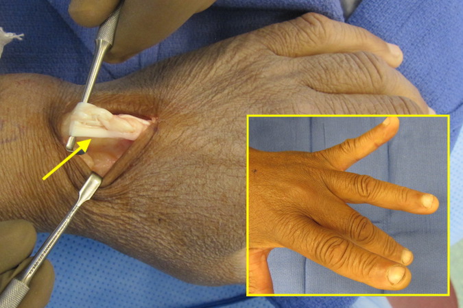 After lipoma excision patient did not regain complete extension (insertion). His deficiency was corrected with a site-to-side tendon transfer (arrow).