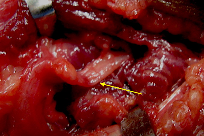 Note the area of compression (arrow) in the posterior interosseous nerve after lipoma excision.