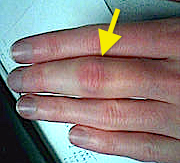 Left long finger PIP joint grade 2 sprain