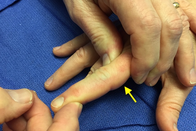 Right index finger PIP joint radial collateral ligament (arrow) exam.