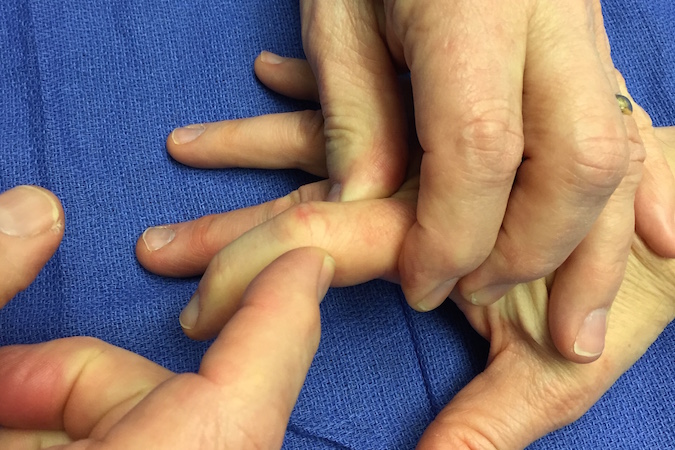 Palpation of PIP joint radial collateral ligament (RCL) for tenderness