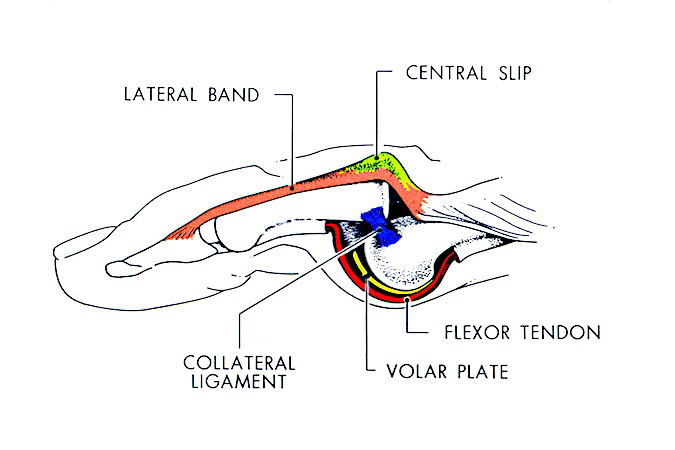 Dorsal PIP Dislocation Bayonet Type Mechanism: Volar plate ruptured off base of middle phalanx; proper collateral (blue) separated from accessory collateral (not shown).