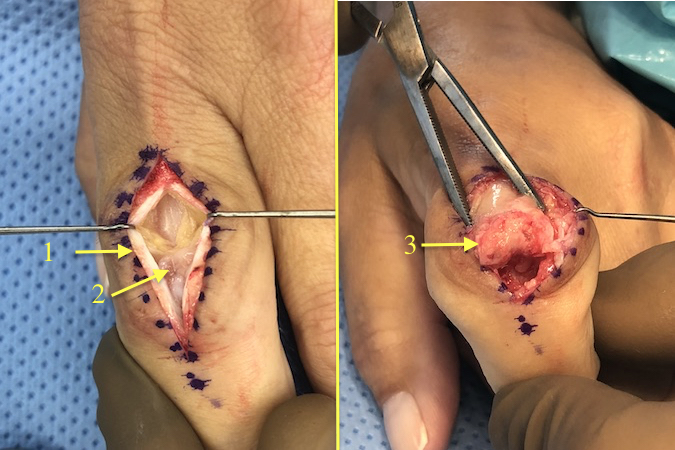 Index PIP joint OA with open extensor hood and joint capsule (1); Note synovitis (2); Note severely damaged cartilage