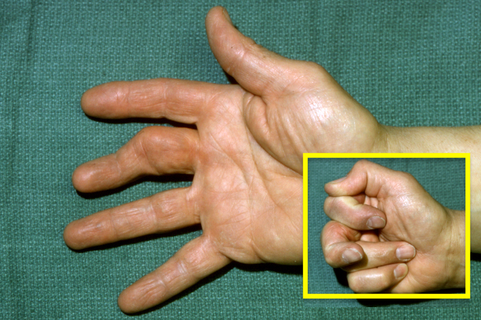 OA right long finger PIP joint.  Note joint deformity and lack of flexion (insert).